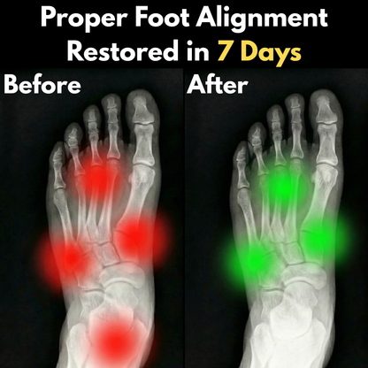 FootAlign™ Relief Sleeve